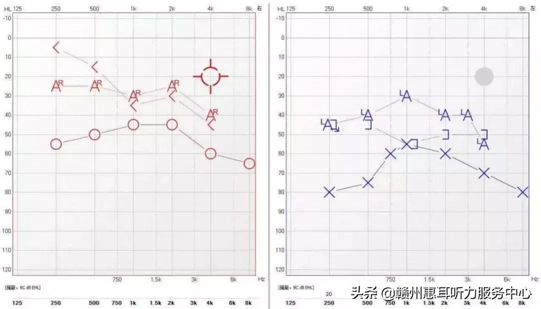 北京耳蜗专家张教授，深耕医学领域，引领听力健康新篇章