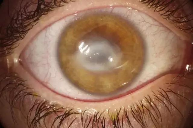 隐形眼镜不能沾水真假探究