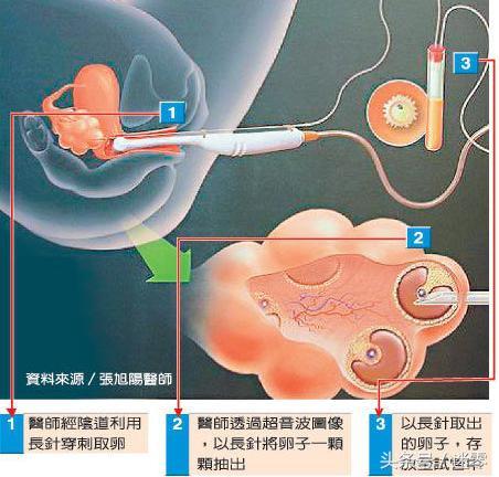 试管二代技术中的取精与取卵时间研究