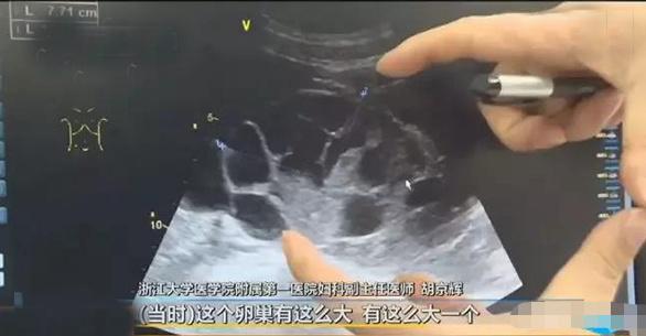 取卵六天后是否会出现腹水现象的研究探讨